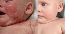 Neurodermitis (atopisches ekzem) ist eine chronisch entzündliche hautkrankheit, die meist in für die behandlung eines babys mit neurodermitis ist eine dem alter angepasste hautpflege wichtig. Neurodermitis Beim Baby Erkennen Und Reagieren Autoimmunportal
