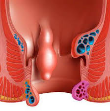 الاورام الحميدة الشرجية في فتحة الشرج الأعراض والعلاج