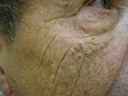 The comedones are widened openings for hair follicles and sebaceous glands filled with material. Favre Racouchot Syndrome Nodular Elastosis Elastoidosis With Cysts And Comedones Senile Or Solar Comedones Smokers Comedones Dermatology Advisor