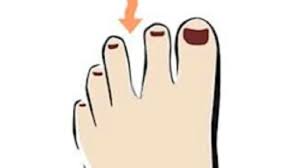 Bill tweak di antara ibu jari dan telunjuk. 7 Macam Kepribadian Dari Bentuk Kaki Kamu Yang Mana Citizen6 Liputan6 Com