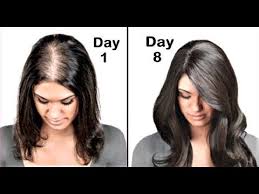 She Had Very Thin Hair She Used This Got Thick Hair In 1 Week Onion Juice For Hair Growth Https Ift Tt 2m Thick Hair Styles Thining Hair Get Thicker Hair