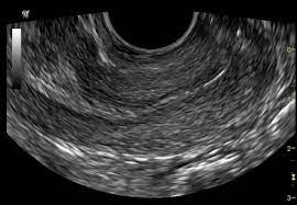 However, ultrasound technology picks up things that aren't. Normal Pelvic Ultrasound Transvaginal Radiology Case Radiopaedia Org