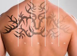 Though the laser used in laser hair removal is different from the one used in laser tattoo removal, it does make an impact on the ink. Laser Tattoo Removal Laser Hair Removal Milton Keynes