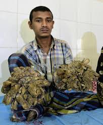 First female to suffer from 'tree man syndrome' undergoes successful surgery. After 24 Surgeries Bangladesh Tree Man Relapses