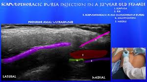 Image result for Scapulothoracic Injection