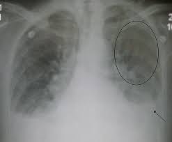 • it can be acute, subacute, or chronic, and. Cardiac Insufficiency Chf Heart Failure And Pulmonary Edema