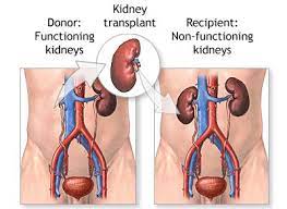 Whereas the average cost of dialysis is £30,800 (data from 2009, and is likely to change with the introduction of a national tariff) in. Aes20 Kidney Transplant Jpg Wiki Anatomy For Engineering Students
