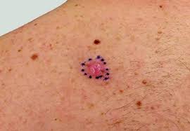 Skin Cancer Risk in Immunosuppressed ...