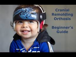 Cranial Remolding Orthosis (Helmet) Beginner's Guide