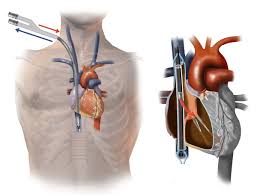 Echo Guided Bi Caval Dual Lumen Ecmo Catheter Insertion