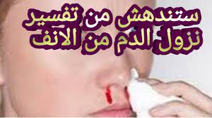 ذكر الإمام ابن سيرين رحمه الله بأن رؤية مخاط الأنف في الحلم بشكل عام قد تدل على أكثر من معنى حيث جاء في أبرز هذه المعاني بأن المخاط غالباً ما يشير الى الرزق سواء بالمال والثروة أو بالولد والبنت والذرية بشكل عام أو الرزق بالزوج والزوجة وقيل أيضاً بأن التمخيط في المنام قد. ØªÙØ³ÙŠØ± Ø­Ù„Ù… Ø±Ø¤ÙŠØ© Ù†Ø²ÙˆÙ„ Ø§Ù„Ø¯Ù… Ù…Ù† Ø§Ù„Ø§Ù†Ù ÙÙ‰ Ø§Ù„Ù…Ù†Ø§Ù… Ù…Ø§ Ù‡Ùˆ ØªÙØ³ÙŠØ± Ø­Ù„Ù… Ù†Ø²ÙˆÙ„ Ø§Ù„Ø¯Ù… Ù…Ù† Ø§Ù„Ø£Ù†Ù ÙÙ‰ Ø§Ù„Ù…Ù†Ø§Ù… Youtube