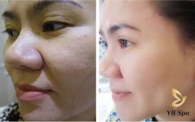 Nên Lăn Kim Hay Peel Da? Cái Nào Tốt Hơn? Lưu ý Cần Biết