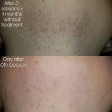 Our professionals use a very fine and delicate probe that transmits heat energy, the probe is inserted into the hair follicle one at a time and the heat energy destroys it, making the hair unable to regrow. Electrolysis Reviews Was It Worth It Realself