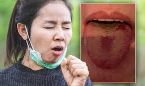 Covid tongue is an inflammatory disorder that usually appears on the top and sides of the tongue. Covid Tongue Warning The Strange Symptom Of Coronavirus In Your Mouth Express Co Uk