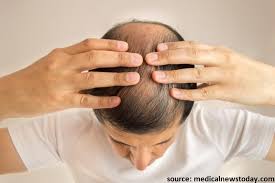 There, it may attach to hair follicles for a considerable time. The Link Between Testosterone And Hair Loss La Densitae