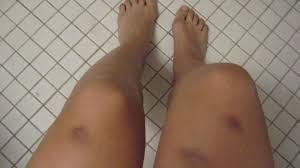 Bacaklarda Kasinti Morarma