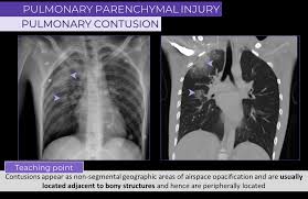 Image result for Pulmonary Contusion