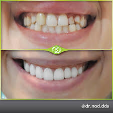 Composite bonding (also known as tooth bonding or dental bonding) offers a solution for minor damage or gaps in teeth. Composite Bonding From 65 Synergy Dental Clinics