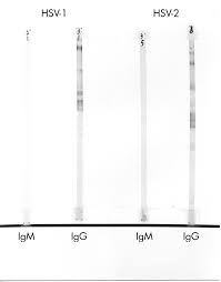 Herpes igg and igm test for different phases of infection. Is Hsv Serology Useful For The Management Of First Episode Genital Herpes Sexually Transmitted Infections