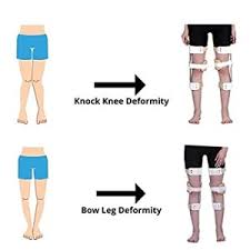 Image result for Genu Varum