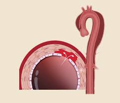 Image result for Aortic Dissection
