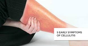 Normal skin has many types of bacteria living on it. 5 Early Symptoms Of Cellulitis Causes Treatment And Faq S
