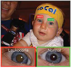 These contrast with benign tumors, which do not spread. Smartphone App Can Help Detect Leukocoria A Sign Of Eye Cancer Shots Health News Npr