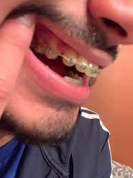 However, if you have serious issues with crookedness and gaps, then it may take a bit longer for treatment. How Long Do You Think It Will Take To Close This Gap Braces