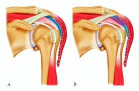 In the world of shoulder pain and pathology, this is often referred to as scapular dyskinesia. A Schematic Anatomy Of A Healthy Glenohumeral Joint And Subacromial Download Scientific Diagram