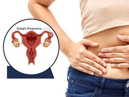 No intrauterine pregnancy is seen on the most common location for ectopic pregnancy to occur is in one of the fallopian tubes. Ectopic Pregnancy