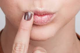 Apabila sudut bibir kering, kulit akan mudah retak dan cedera. Mrs Wawa Ashihara Ketahui Sebab Kenapa Kita Perlu Exfoliate Bibir
