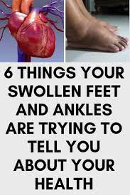 6 Things Your Swollen Feet And Ankles Are Trying To Tell You About Your Health Swollen Feet Swollen Ankles Remedy Ankle Swelling Causes