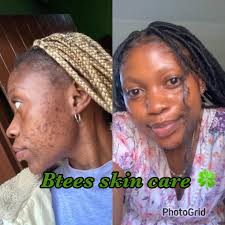 What is good for crepey dry skin?