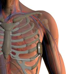 18 bloom h, heeke b, leon a, mera f, delurgio d, beshai j, langberg j. Advances In Implantable Cardioverter Defibrillator Technology Daic