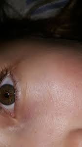 Was Kann Das Im Auge Sein Gesundheit Augen Verschwommen