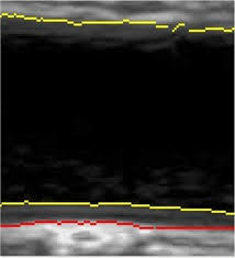 July 24, 2021updated july 24, 2021, 10:16 a.m. Vascular Adaptations In Nonstimulated Areas During Hybrid Cycling Or Handcycling In People With A Spinal Cord Injury A Pilot Study Of 10 Cases Spinal Cord Series And Cases
