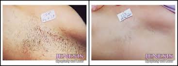 Some people reading this article will be a bit disgusted. Laser Hair Removal San Jose Permanent Hair Removal San Francisco Depilation California