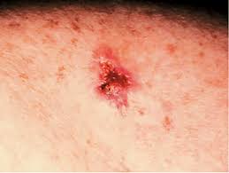 Read about cancer symptoms fungating wounds from secondary tumours Skin Cancer Information The Skin Cancer Foundation