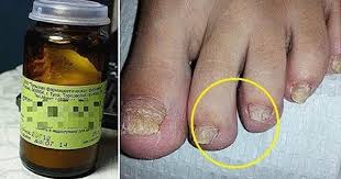 как сделать мазь от грибка ногтей из яйца и уксуса Ideya Ot Polzovatelya Aharon Salidar Na Doske Zdorove V 2020 G Zdorove Zdorove Serdca Fakty O Zdorove