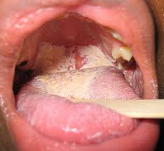 Image result for Oral thrush roof of mouth