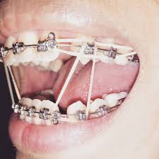 Braces Girlswithbraces Metalbraces Elastics Hooks Zahnspange Zahne Zahne Ziehen