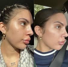 Before and after just 1 Halo laser resurfacing treatment! 🤩 Look at that  improvement in texture and tone in just 3 weeks. Abigail's main concern was  to diminish the appearance of her