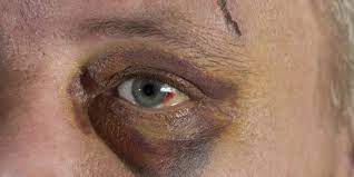 Blaues Auge Ursachen Verlauf Und Wirksame Hausmittel Heilpraxis