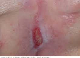 Check spelling or type a new query. Bedsores Pressure Ulcers Symptoms And Causes Mayo Clinic