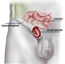 >testiculele, care se află suspendate la nivelul scrotului, constituie sediul producerii spermei. Hernia Inghinala Operatie Clasica Sau Laparoscopica Dr Teodor Buliga