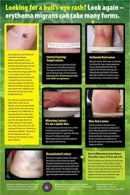Image result for infected tick bite