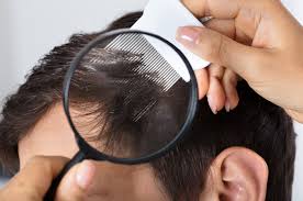 <p>hijaber tidak lepas dari masalah rambut. Ketombe Bandel Jangan Jangan Dermatitis Seboroik