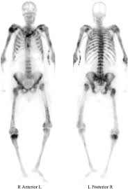 My dad was diagnosed with metastatic prostate cancer six months ago. Whole Body Bone Scan Of 83 Year Old Man With Metastatic Prostate Cancer Download Scientific Diagram
