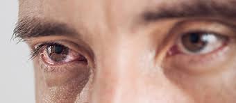 Symptoms of an eye infection, like pink eye, include itching, burning, redness, watery eye and crustiness. Primary Eyecare Provides Nhs Funded Eyecare Services Via Local Opticians