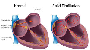 Image result for Atrial Fibrillation
